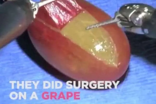 Close-up of a grape gripped by surgical instruments with its skin peeled back, captioned "THEY DID SURGERY ON A GRAPE"
